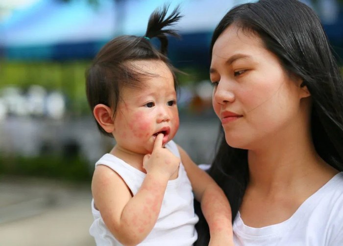 Cara mencegah Alergi pada anak